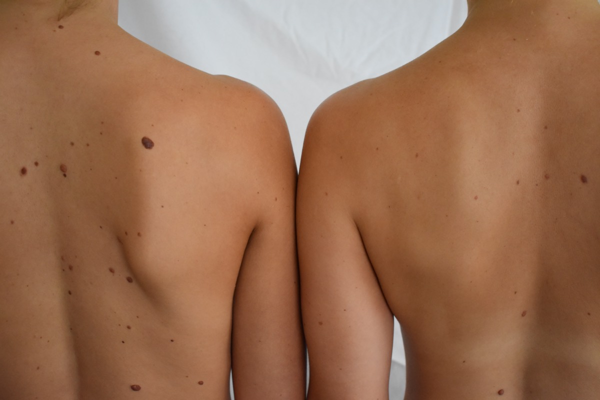 Two backs side by side after tanning, the colour even across both skin tones.